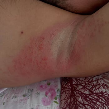 Veet Kremi Nedeniyle İkinci Derece Yanık, Hastane Masrafları Ve Tatil İptali