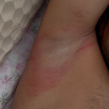 Veet Kremi Nedeniyle İkinci Derece Yanık, Hastane Masrafları Ve Tatil İptali