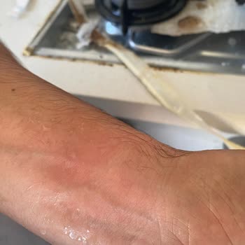 Arçelik Cam Ocak Patlaması: Güvenlik İhlali Ve Ücretsiz Değişim Talebi