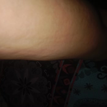 Qsmok 150 Mg Kullanımında Şiddetli Alerjik Reaksiyonlar Ve Yetersiz Uyarı