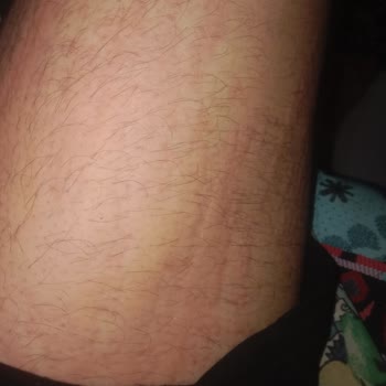 Qsmok 150 Mg Kullanımında Şiddetli Alerjik Reaksiyonlar Ve Yetersiz Uyarı