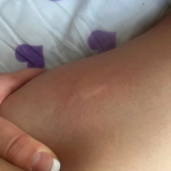 Antalya Büyükşehir Belediyesi’nden Acil Ve Etkili Sivrisinek İlaçlaması Talebi