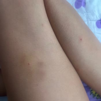 Antalya Büyükşehir Belediyesi’nden Acil Ve Etkili Sivrisinek İlaçlaması Talebi