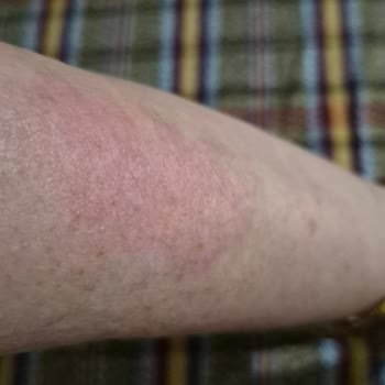 Yves Rocher Güneş Kremi Alerjisi Ve Yetersiz Müşteri Hizmeti
