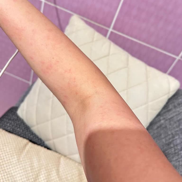 Yves Rocher Monoi Vücut Yağı Nedeniyle Şiddetli Alerjik Reaksiyon Ve Sağlık Harcaması