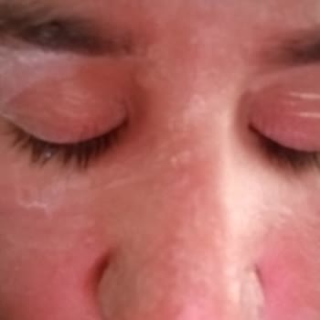 Dermokil SPF 50 Güneş Kremi Kullanımında Cilt Yanması Ve Ücret İadesi Talebi