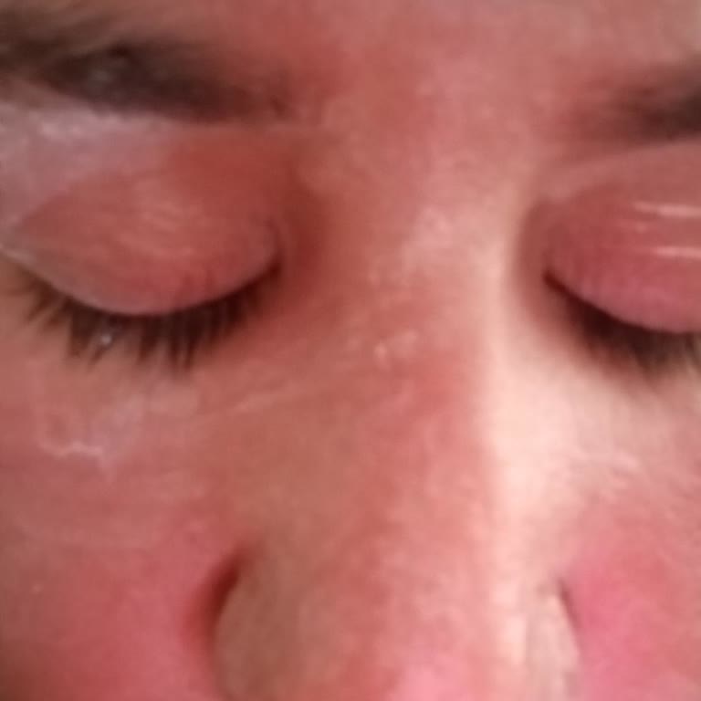 Dermokil SPF 50 Güneş Kremi Kullanımında Cilt Yanması Ve Ücret İadesi Talebi