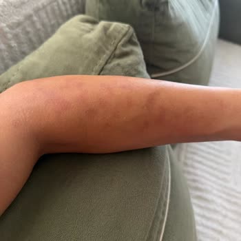 Aşırı Isı Ve Yanık Nedeniyle Yaşadığım Lazer Epilasyon Mağduriyetim