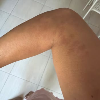 Aşırı Isı Ve Yanık Nedeniyle Yaşadığım Lazer Epilasyon Mağduriyetim