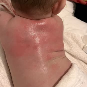 Sleepy Natural Bebek Bezinde Cilt Kızarıklıkları Ve Hassasiyet