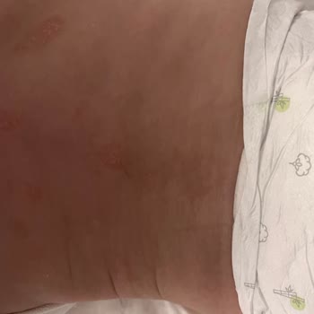 Sleepy Natural Bebek Bezinde Cilt Kızarıklıkları Ve Hassasiyet