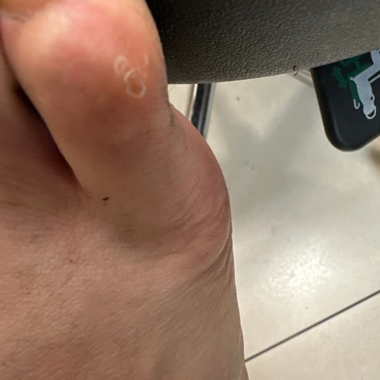Converse Ayakkabısının Sağ Parmak Yaralanması Ve Topuk Kırılması