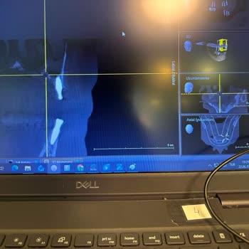 Sağlık Bakanlığı Yanlış Implant Uygulaması Sonrası Hekim Soruşturma Ve Yeniden Tedavi Talebi