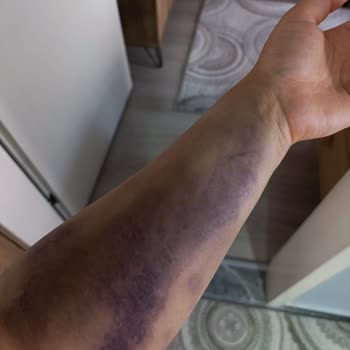 Kan Bağışı Sırasında Damar Yırtılması Ve İlgisiz Personel