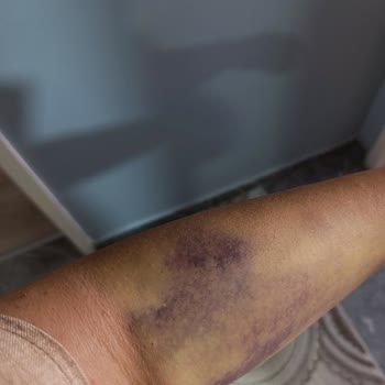 Kan Bağışı Sırasında Damar Yırtılması Ve İlgisiz Personel