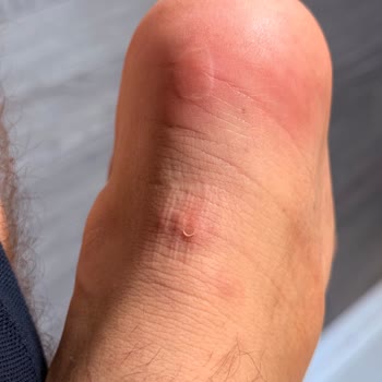 Ayakkabının Topuktan Yara Açması Ve Değişim Talebinin Reddedilmesi