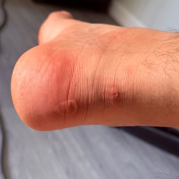 Ayakkabının Topuktan Yara Açması Ve Değişim Talebinin Reddedilmesi