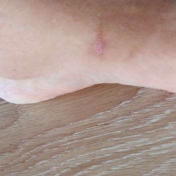 Deichmann Mağazasında Aldığım Terlik Ayaklarımı Yara Yaptı Ve İlgisiz Yaklaşım Güvenimi Sarstı