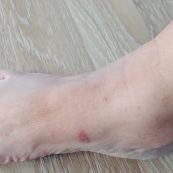 Deichmann Mağazasında Aldığım Terlik Ayaklarımı Yara Yaptı Ve İlgisiz Yaklaşım Güvenimi Sarstı