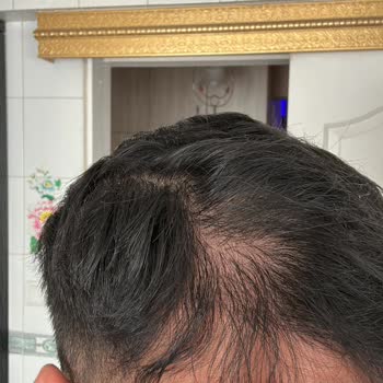Helsa Hair Clinic Hem Maddi Hem Manevi Olarak Ciddi Anlamda Mağdur Oldum