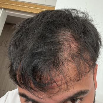 Helsa Hair Klinik’te Saç Ekimi Sonuçsuz Kaldı, Ücret İadesi Ve Tazminat Talebi