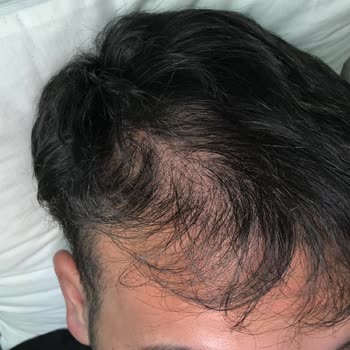 Helsa Hair Klinik’te Saç Ekimi Sonuçsuz Kaldı, Ücret İadesi Ve Tazminat Talebi