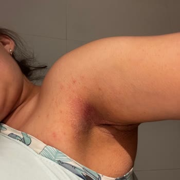 Desodorante Dove Invisible Care causa reacción alérgica severa, pido revisión