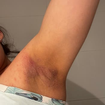 Desodorante Dove Invisible Care causa reacción alérgica severa, pido revisión