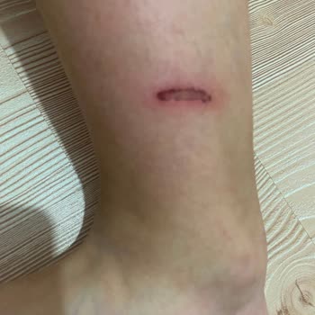Toyas Pateni Süngeri Parçalandı, Çocuğum Yaralandı Ve İade Talep Ediyorum