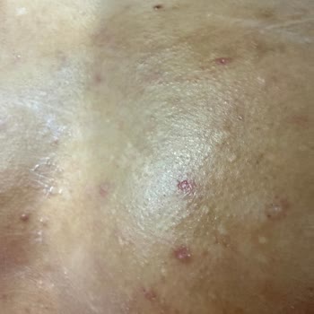 Lure Tüy Dökücü Kremin Şiddetli Yanma Ve Yanık Şikayeti