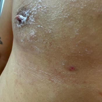 Lure Tüy Dökücü Kremin Şiddetli Yanma Ve Yanık Şikayeti
