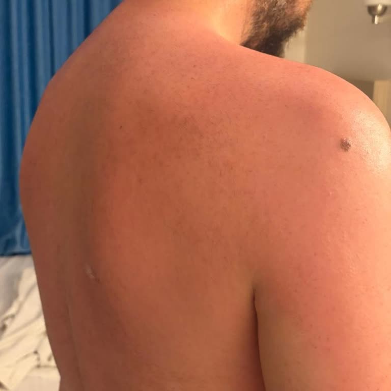 Dermokil Güneş Spreyi Suya Dayanıklı İddiası Yanıltıcı, Yanık Oluşturdu
