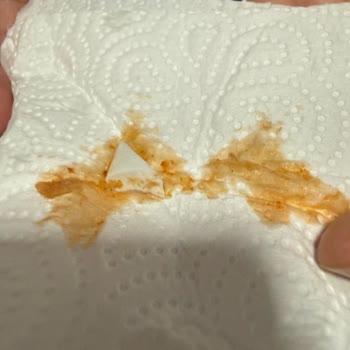 İskender Siparişinde Kırık Porselen Parçası Bulunması Sağlık Tehlikesi