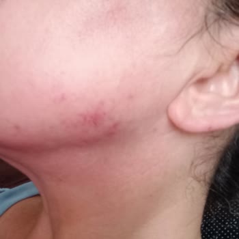 Note Ürünleriyle Alerjik Reaksiyon Yaşayan Hassas Cilt Kullanıcıları Dikkat