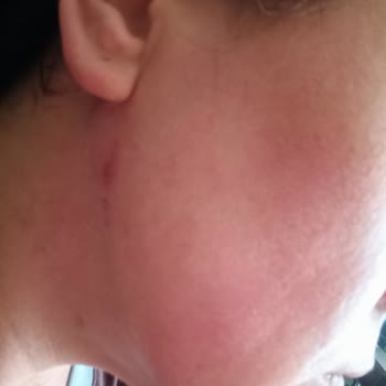 Note Ürünleriyle Alerjik Reaksiyon Yaşayan Hassas Cilt Kullanıcıları Dikkat