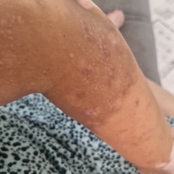 Bayraklı Şubesinde Lazer Epilasyon Sonrası Yanık Ve İz Şikayeti