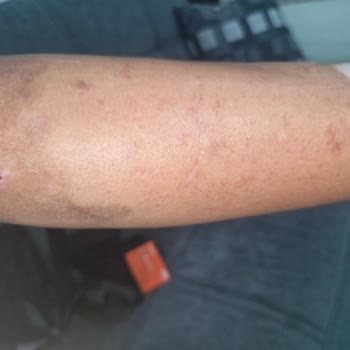 Bayraklı Şubesinde Lazer Epilasyon Sonrası Yanık Ve İz Şikayeti