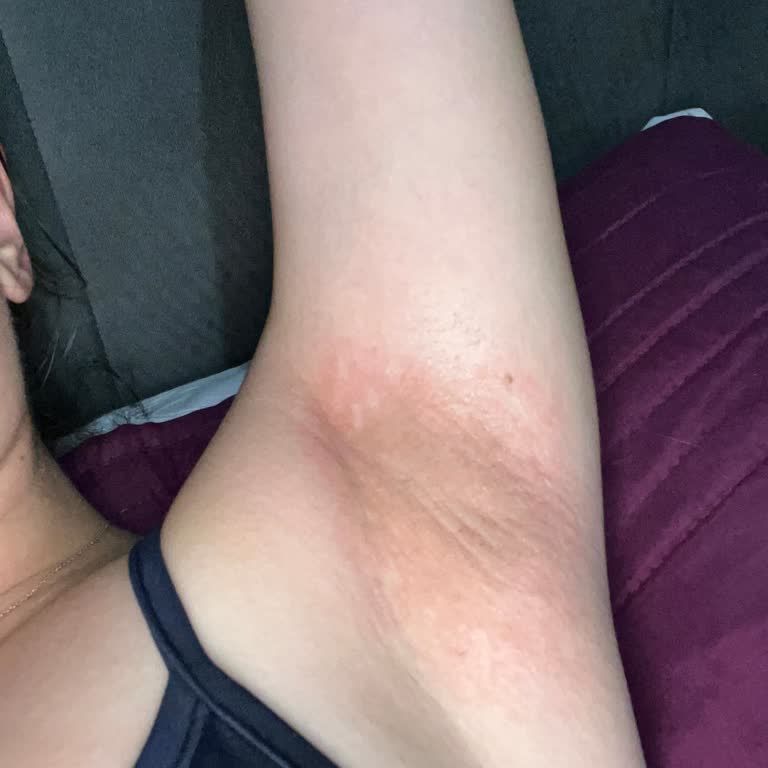Yves Rocher Antiperspirant Alerjik Reaksiyon Ve Cevapsız Müşteri Desteği