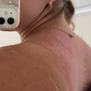 Mustela Güneş Kremi İle 2. Derece Yanık Ve Kalıcı Lekeler