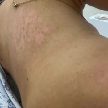 Mustela Güneş Kremi İle 2. Derece Yanık Ve Kalıcı Lekeler
