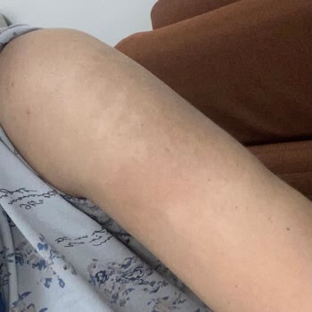 Mustela Güneş Kremi İle 2. Derece Yanık Ve Kalıcı Lekeler