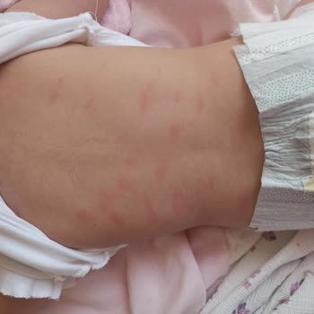 Bebekte Şampuan Kullanımından Kızarıklık Ve Güven Kaybı