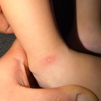 Ayağında Yara Açan Kaygan Çocuk Sandaleti Ve Çözüm Bulamayan Mağaza