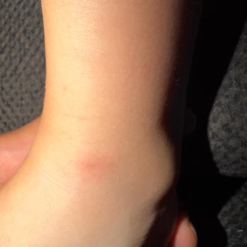 Ayağında Yara Açan Kaygan Çocuk Sandaleti Ve Çözüm Bulamayan Mağaza