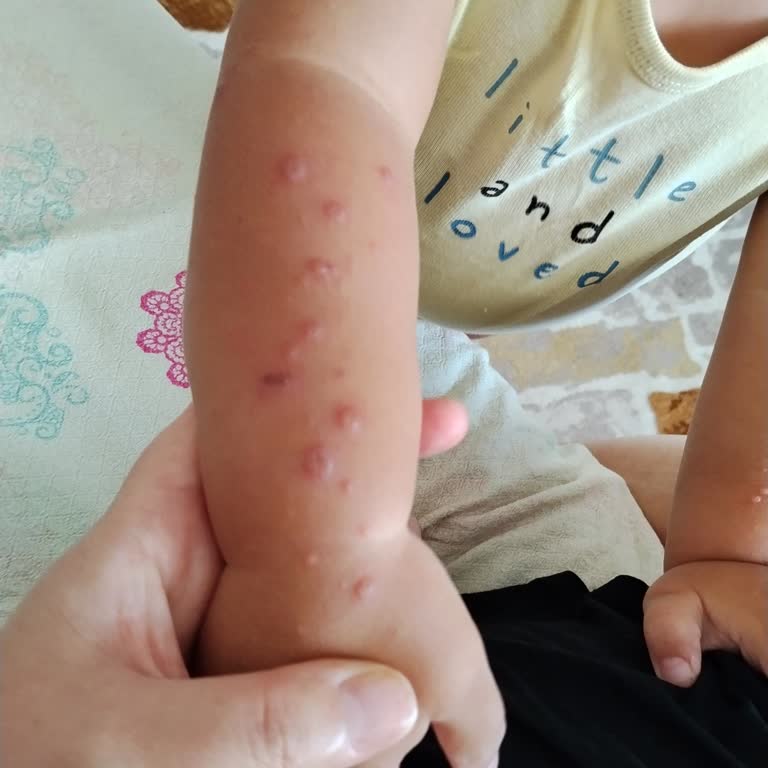 Otel Havuzunun Hijyeni Nedeniyle Çocuklarımın Hastalanması Ve Ücret İadesi Talebi