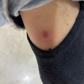 Ayakkabı Hatası Ayağımı Yaraladı Ve İade Talebim Reddedildi