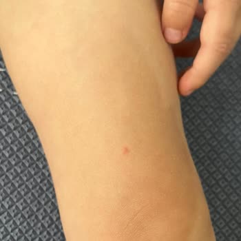 Kirli Havuzda Çocuğumun El Ayak Ağız Hastalığı Ödeme İadesi Talebi