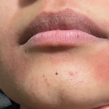 Maruderm Yüz Yıkama Jelinin Kuru Ciltte Aşırı Kurutması Ve Kaşıntı Oluşturması