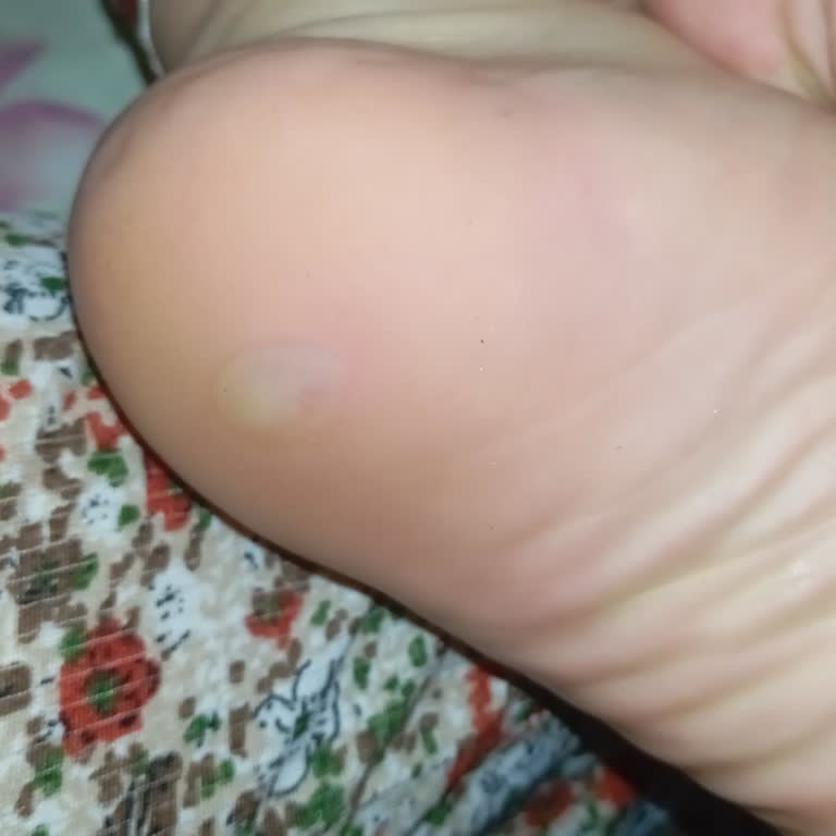 Çivili Tabanlı Topuklu Ayakkabının Yarattığı Ağrı Ve Sağlık Problemi