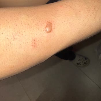 14.000 TL'lik Lazer Epilasyon Paketi Yanık Ve İz Bırakarak Söz Verilen Sonuçları Vermedi